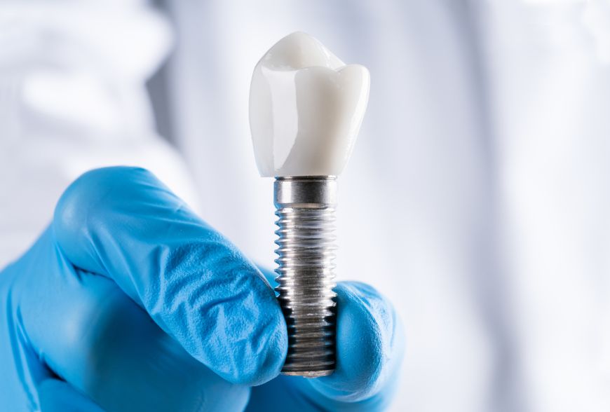 implantes dentales sevilla