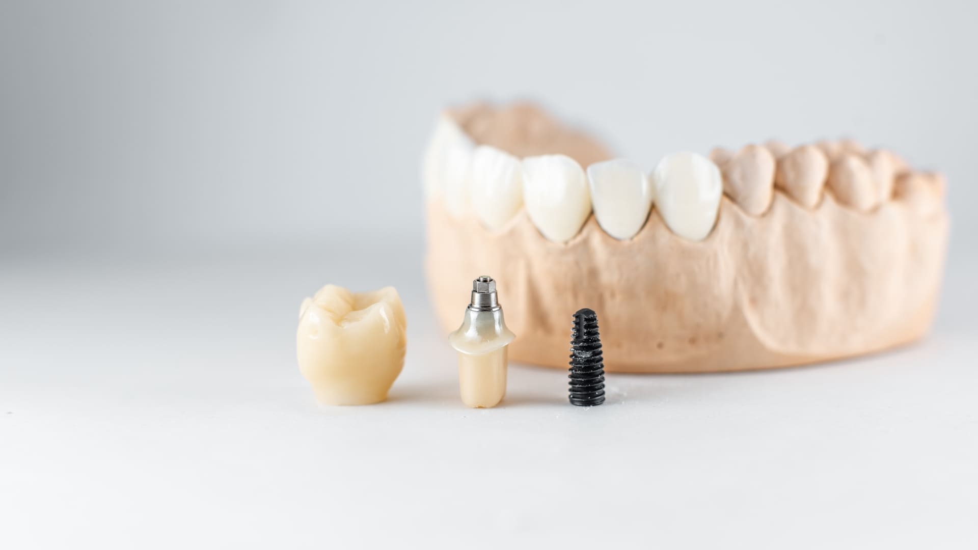 implantes dentales sevilla