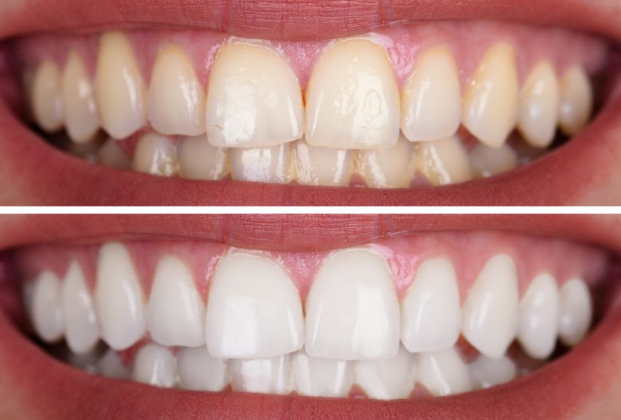 higiene oral