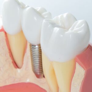 endodoncia en sevilla