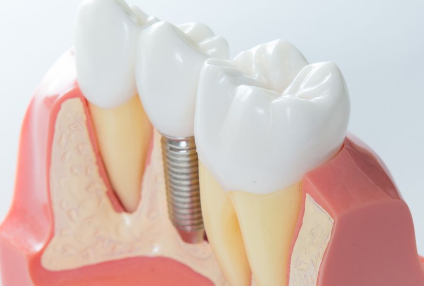 endodoncia en sevilla