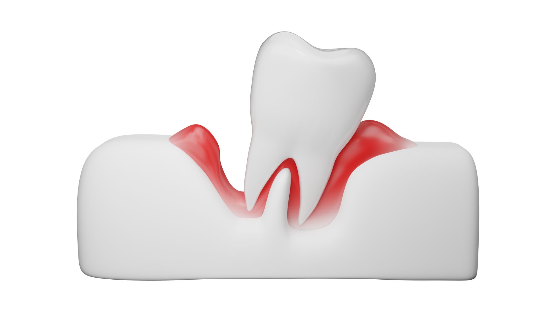 periodontitis sevilla