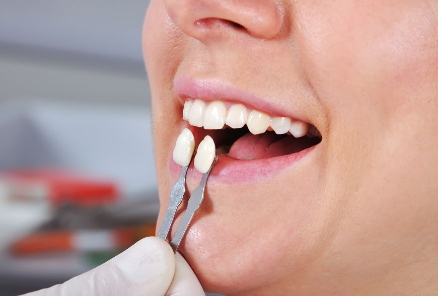 carillas dentales