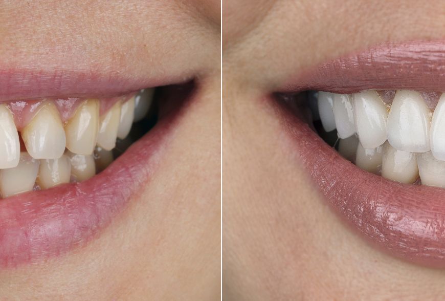 cuanto duran las carillas dentales