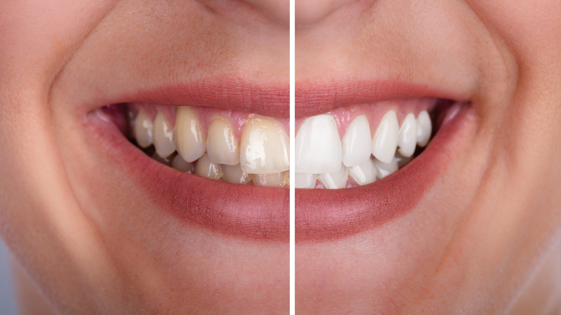 antes y despues blanqueamiento dental