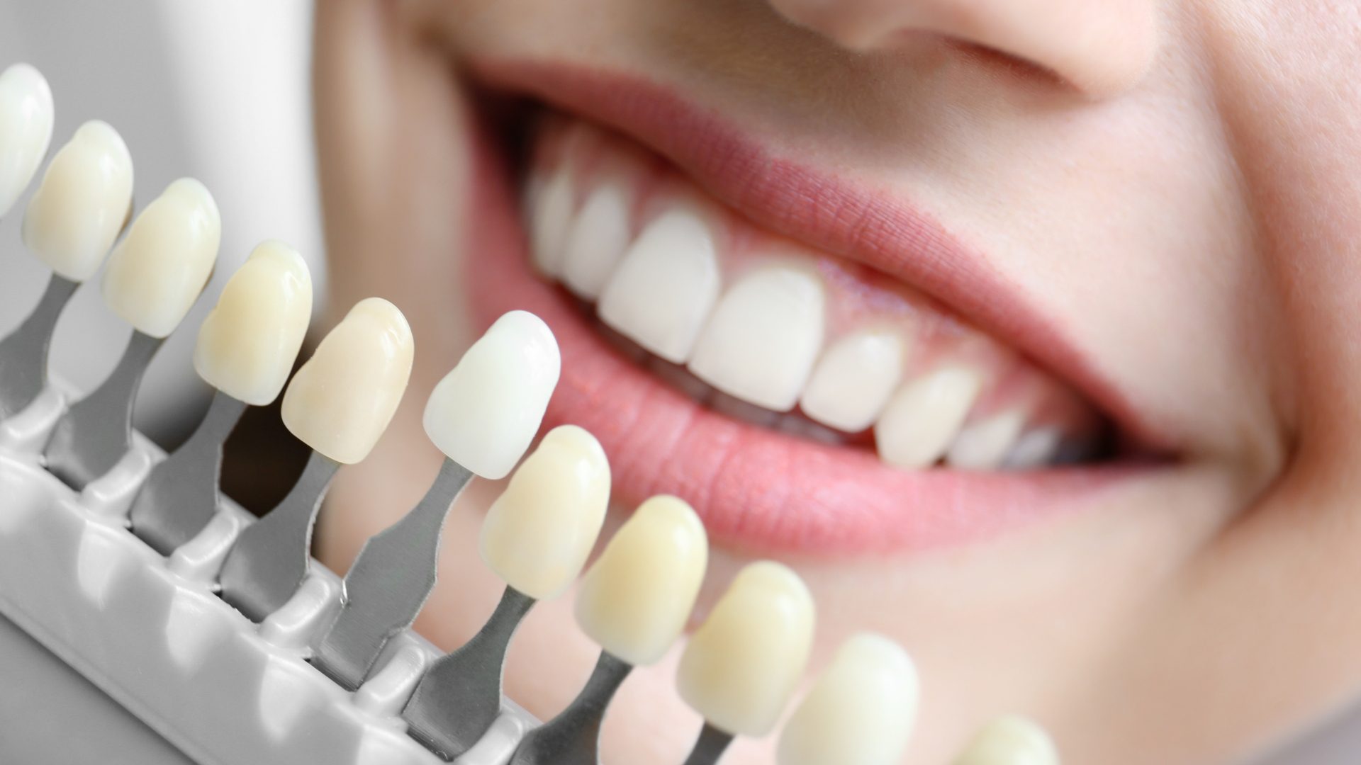 tono blanco carilla dental