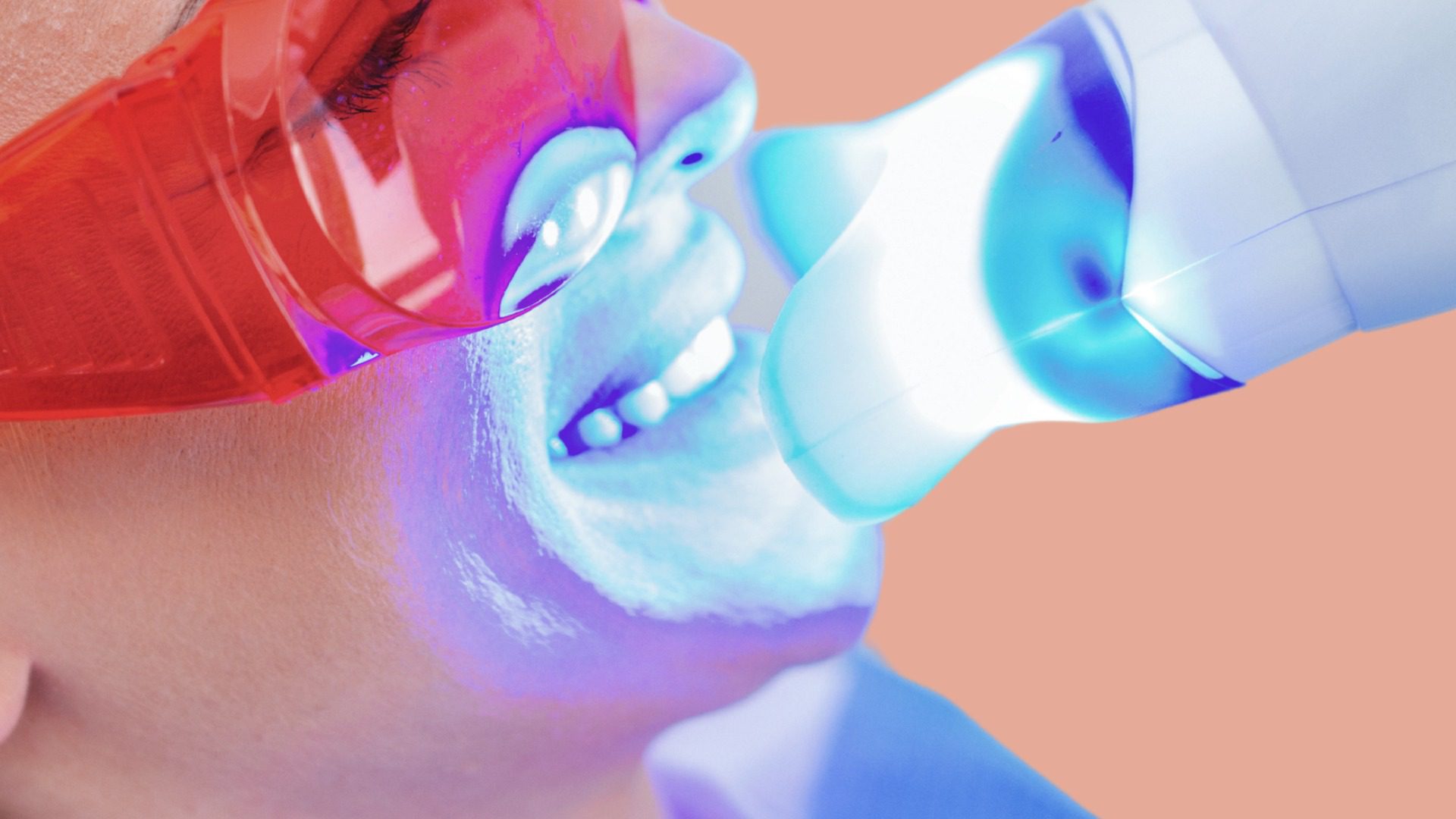 tecnica de blanqueamiento dental