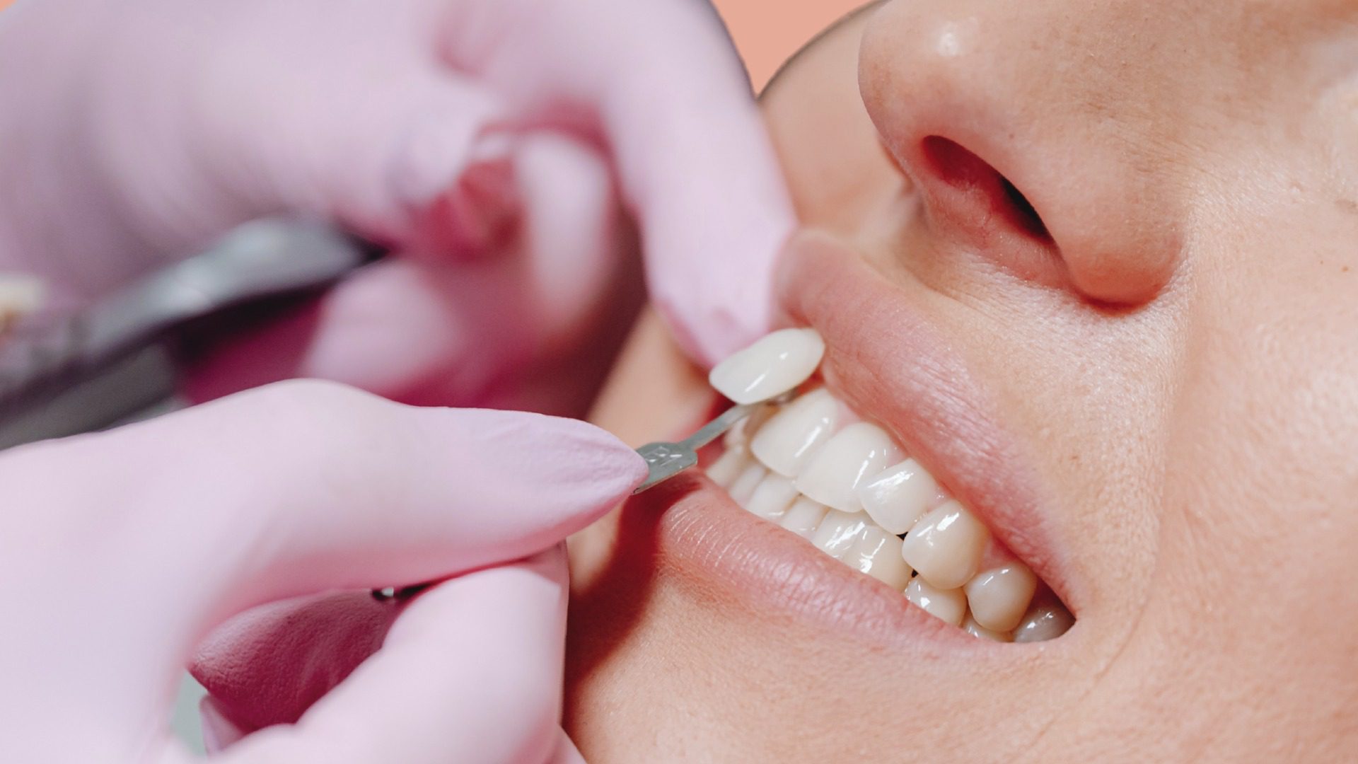 Puesta de carilla dental