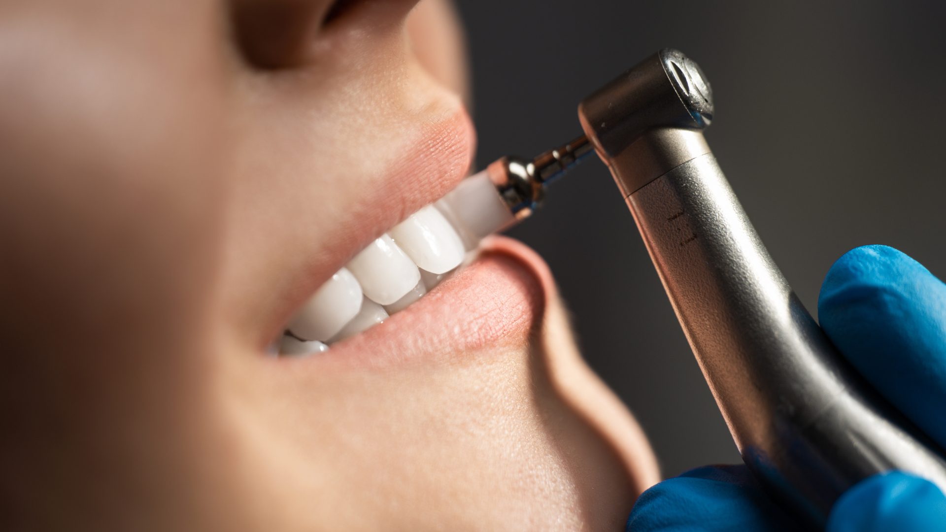 proceso carillas dentales