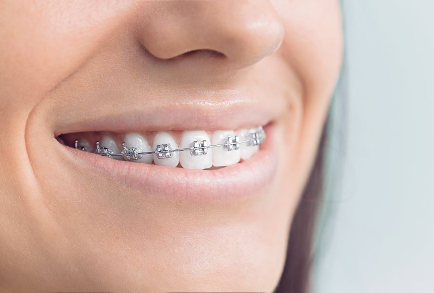 brackets
