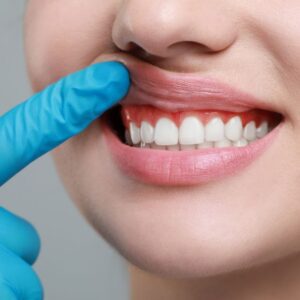 sonrisa gingival